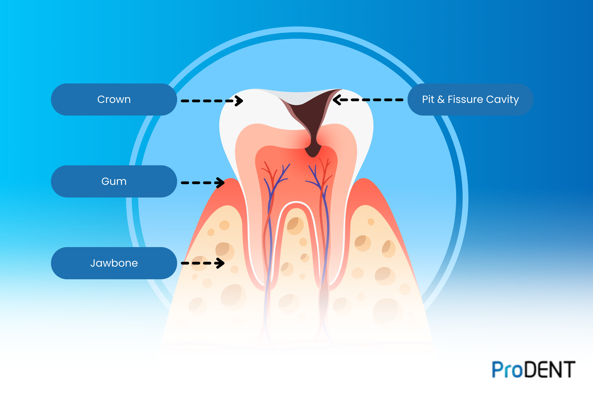 Dental Caries Detection | What do Cavities Look Like?