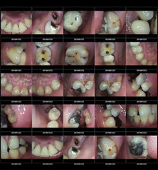 ProDENT PD720 Intraoral Camera