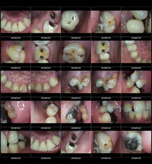 ProDENT HD Intraoral Camera PD720